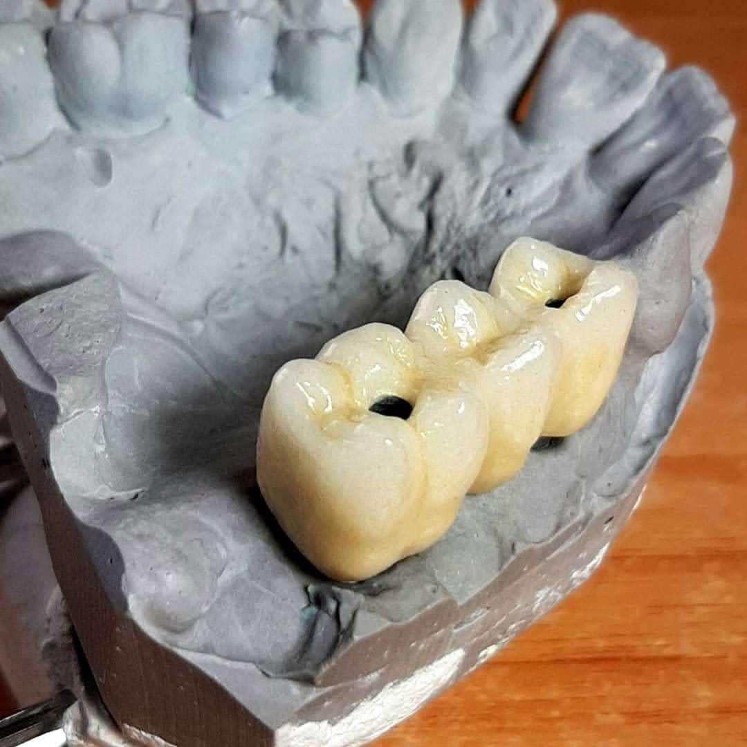 Implantes dentales